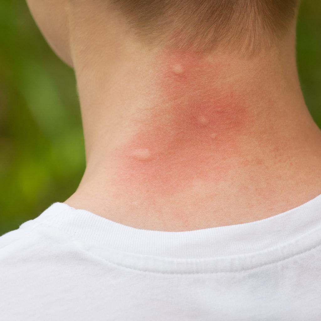 Mosquito bites on the neck.