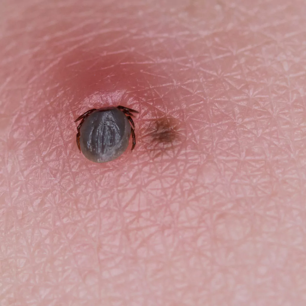 Tick bite in skin
