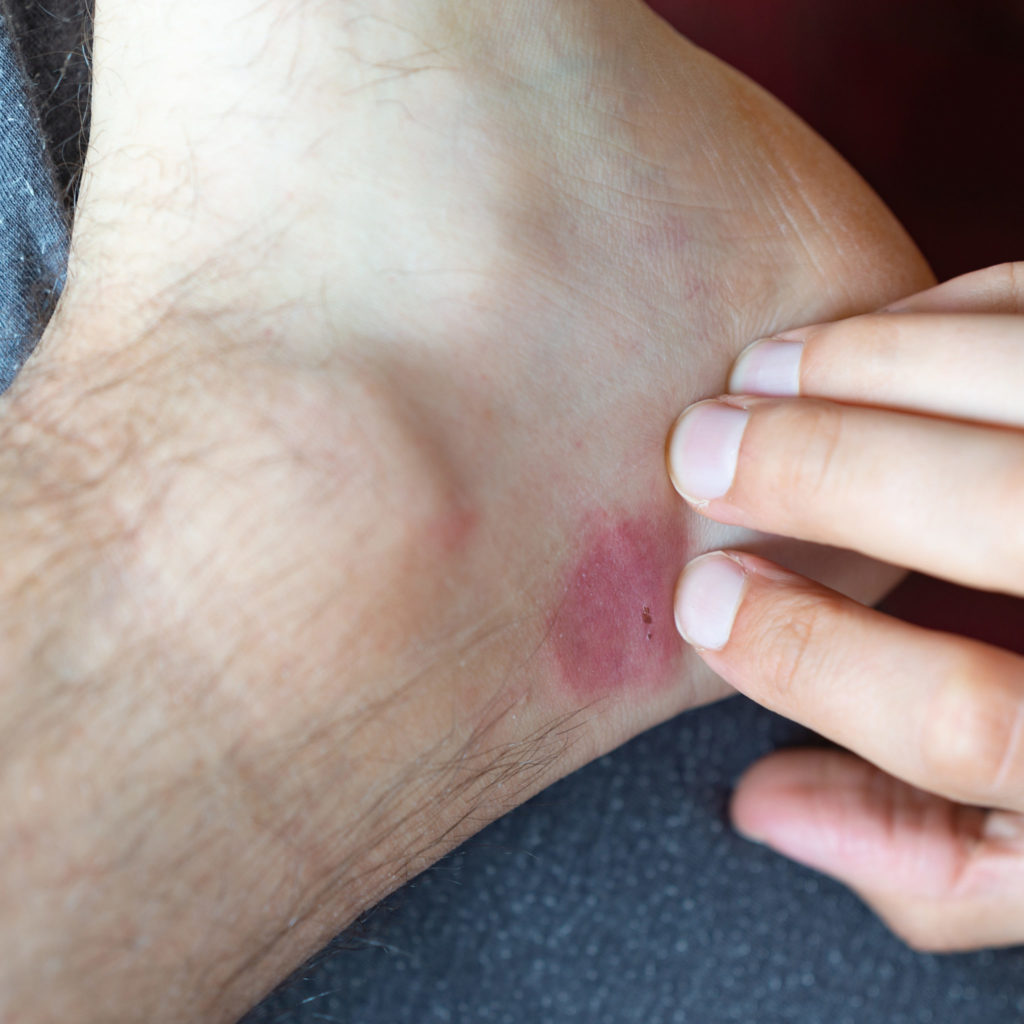 Flea bite on ankle