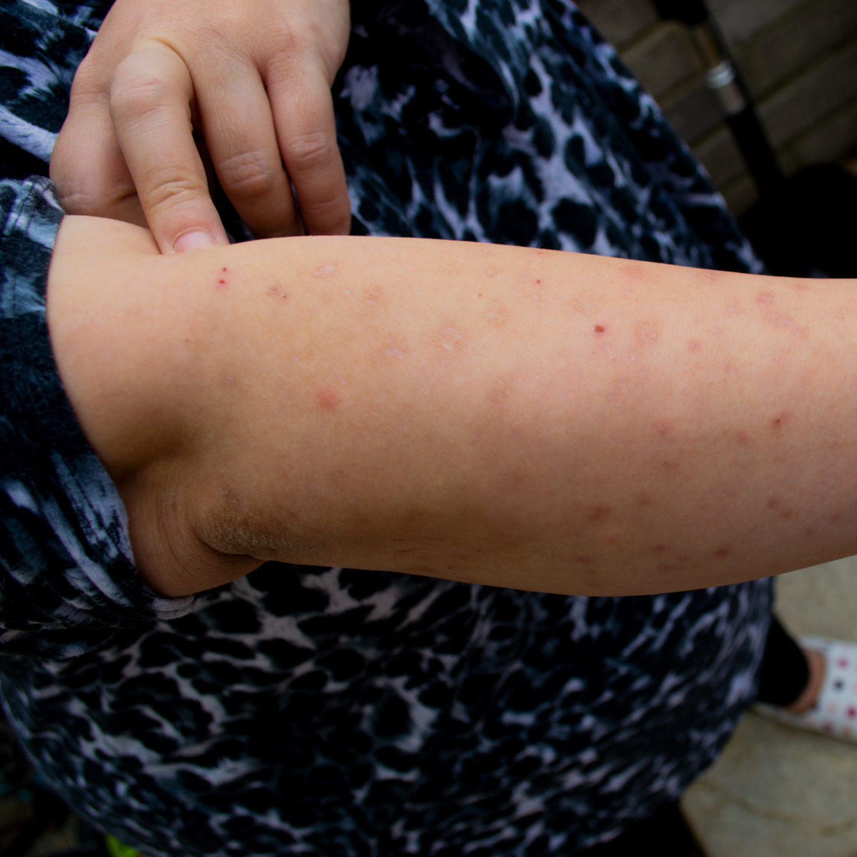 Insect Bites How to Know What Bug Bit You » The Money Pit